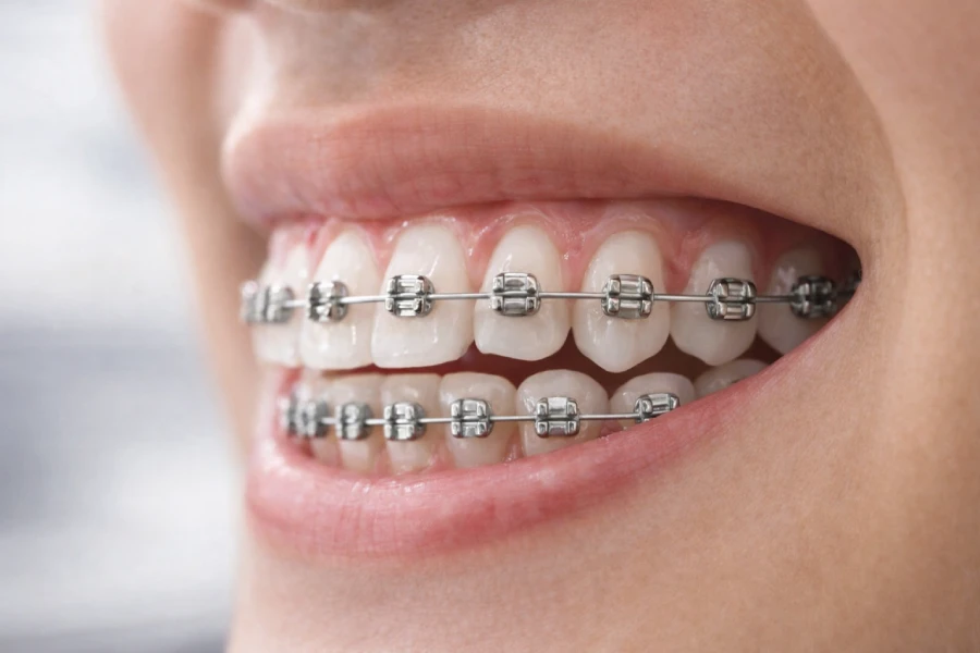 Behel gigi yang terpasang rapi di Kimmi Dental Care Pondok Aren