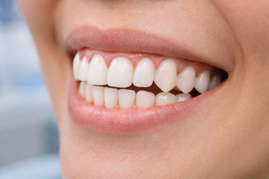 Kondisi gigi bersih setelah scaling karang gigi di Kimmi Dental Care Pondok Aren